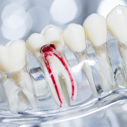 Traitement de canal et soins de dentisterie générale Traitement de canal et soins de dentisterie générale